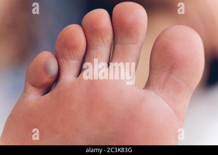 Close-up of man's foot finger with a large blister on the inside of the foot Stock Photo