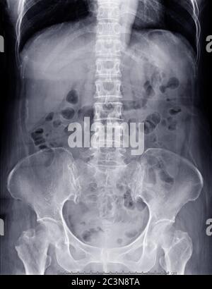 X-ray Abdomen  showing anatomical in abdomen for diagnotic abdominal pain. Stock Photo