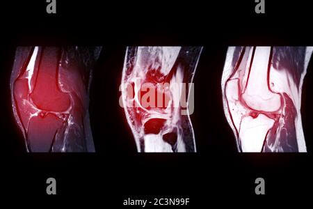 Compare Of Mri Knee Joint Or Magnetic Resonance Imaging Sagital View 