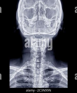 X-ray C-spine or x-ray image of Cervical spine AP  view for diagnostic intervertebral disc herniation. Stock Photo