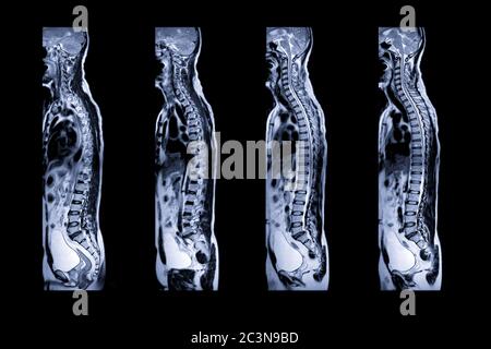 Collection of MRI of whole spine  T2W sagittal  plane for diagnostic Spinal Cord Compression. Stock Photo