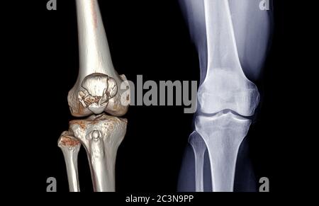 Compare CT knee 3D rendering image and x-ray image AP view isolated on black background Stock Photo