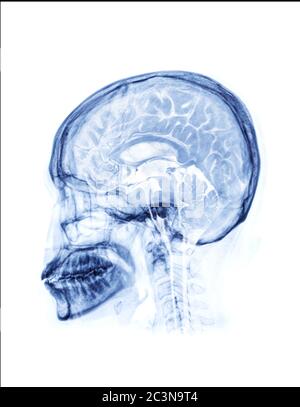 Skull x-ray lateral view with merge MRI brain sagittal view for medical background concept. Stock Photo