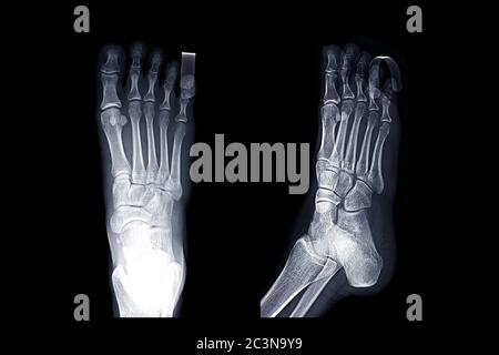 Comparison of X-ray Right foot image  AP  and  oblique  view with  Finger Splint  for diagnostic fracture and Gouty arthritis . Stock Photo