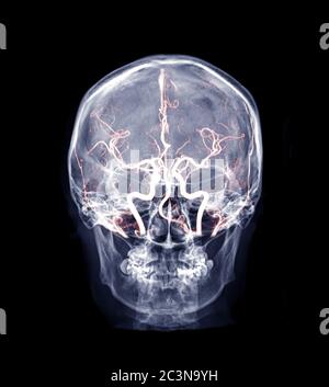 Skull x-ray image of Human skull ap mix MRA Brain image showing cerebral artery of brain in skull. Stock Photo