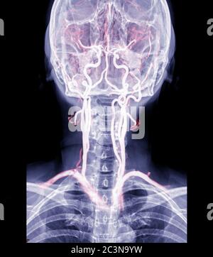 X-ray C-spine or x-ray image of Cervical spine AP  view with cta carotid artery for diagnostic intervertebral disc herniation. Stock Photo