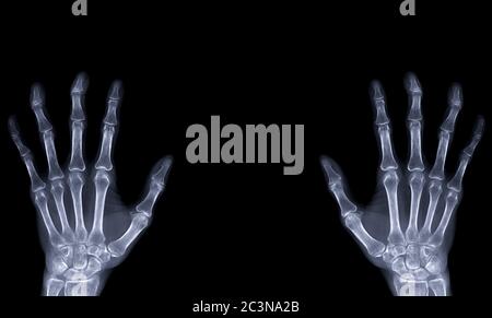 xray image of both hand AP view isolated on black  background  for diagnostic rheumatoid. Stock Photo