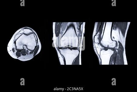 Compare Of Mri Knee Joint Or Magnetic Resonance Imaging Sagital View 