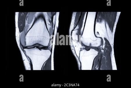 Compare of MRI knee or Magnetic resonance imaging of knee joint stir ...