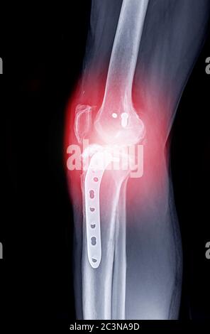 x-ray image of  Right knee Lateral view showing Total knee arthroplasty and fractures of the tibial plateau with plate and screw fixation. Stock Photo