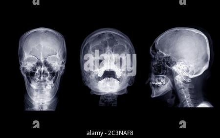 Collection of Skull x-ray image of Human skull  AP  , water's view and Lateral view  isolated on Black Background. Stock Photo