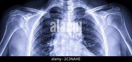 X-ray of both Shoulder joint AP view for diagnosis fracture of shoulder joint. Stock Photo