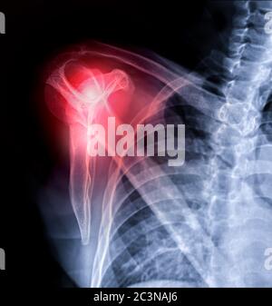 X-ray Shoulder joint transcapular view for diagnosis fracture of shoulder joint. Stock Photo