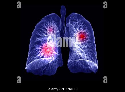 CT Chest or Lung 3D rendering image showing lesion ( Red ) for diagnosis TB,tuberculosis and covid-19 . Stock Photo