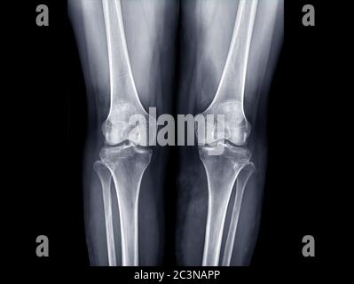 x-ray image of  both knee AP view for detect Osteoarthritis Knee or OA Knee . Stock Photo