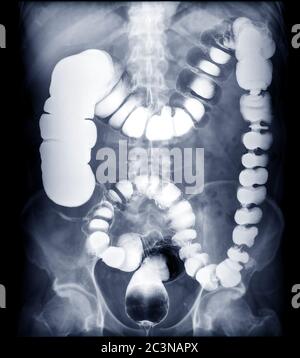 BE or barium enema image or x-ray image of large intestine showing anatomical of colon for detect Colon cancer .