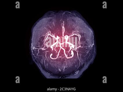 MRA Brain or Magnetic resonance angiography ( MRA )  of cerebral artery in the brain for evaluate them  stenosis  and stroke disease Stock Photo