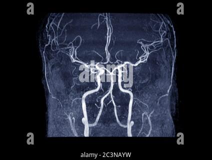 MRA Brain or Magnetic resonance angiography ( MRA )  of cerebral artery in the brain for evaluate them  stenosis  and stroke disease Stock Photo