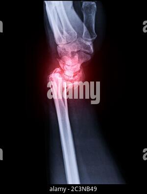 X-ray image of Left wrist joint Lateral view for showing fracture of radius bone. Stock Photo
