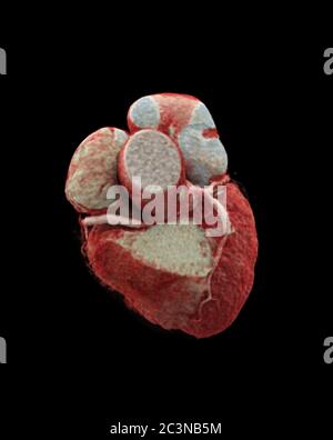 CTA Coronary artery  3D rendering image on the screen for diagnosis of vessel coronary artery stenosis . Stock Photo