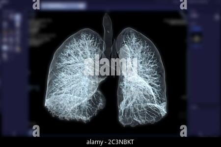 CT Chest or Lung 3D rendering image for diagnosis TB,tuberculosis and covid-19 . Stock Photo