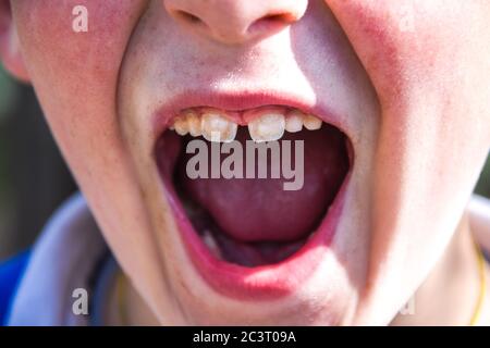 Toddler with mouth opened wide to show lower baby teeth at dental check-up Stock Photo