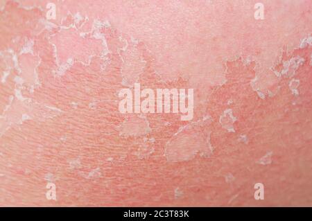 background with the texture of irritated reddened skin with flaking scales and cracks from sunburn and allergies on the human body Stock Photo