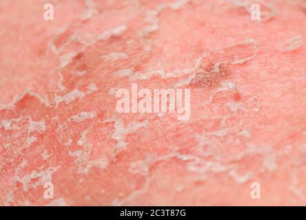 background with the texture of irritated reddened skin with flaking scales and cracks from sunburn and allergies on the human body Stock Photo