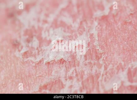 texture of irritated unhealthy skin with scales of dead cells and 