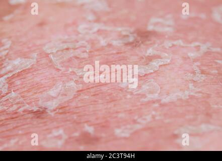 textured background with scales of dead skin cells with redness and pigmentation after sunburn are detached from the body Stock Photo