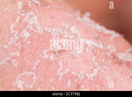 textured background with scales of dead skin cells covered with cracks after sunburn break off from the body Stock Photo