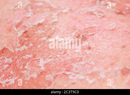 texture of irritated reddened skin with flaking scales and cracks from sunburn and allergies on the human body Stock Photo