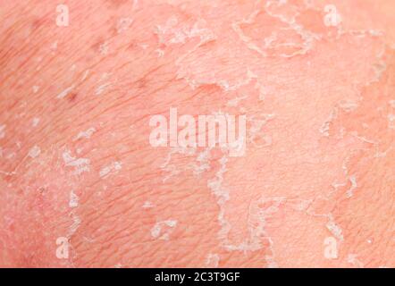 textured background with scales of dead skin cells with redness and pigmentation after sunburn are detached from the body Stock Photo