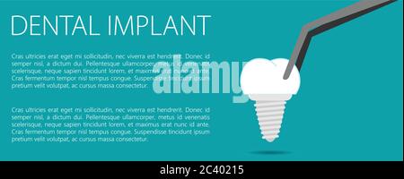 Dental implant flat vector Stock Vector