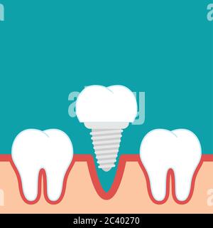 Dental implant flat vector Stock Vector