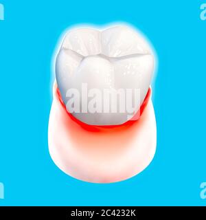 Tooth, sore gum, redness, dentistry, dental cleaning, oral hygiene. Using toothpaste to protect the tooth from plaque formation, 3d render Stock Photo