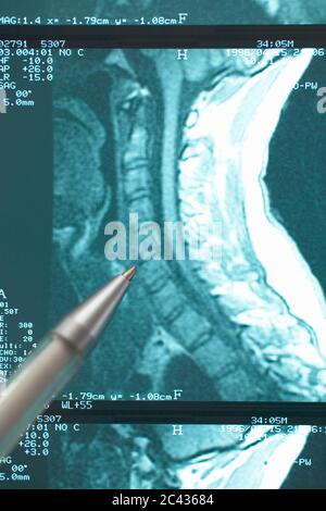 Ballpoint pen lies on x-ray Stock Photo