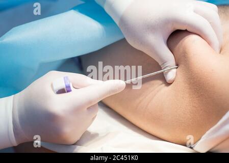 An oncologist, using a long needle, pierces a childs ilium to diagnose bone marrow for leukemia, Ewings sarcoma Stock Photo