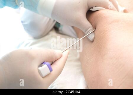 An oncologist, using a long needle, pierces a childs ilium to diagnose bone marrow for leukemia, Ewings sarcoma Stock Photo