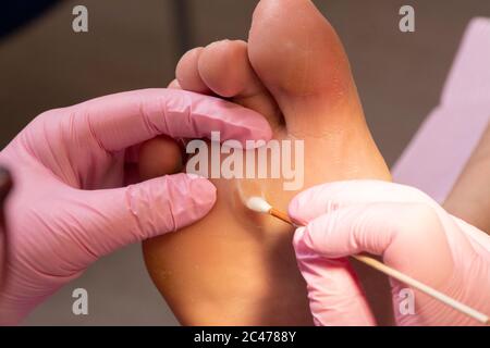 The hands of an unrecognizable female podiatrist with pink gloves cauterizing a callus on one foot with cotton swab Stock Photo