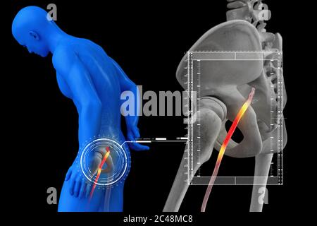 Pinched human sciatic nerve, anatomical vision. 3d illustration. Stock Photo