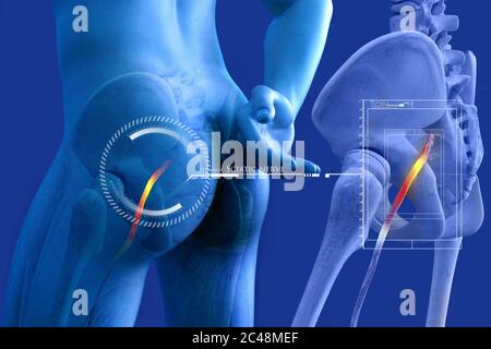 Pinched human sciatic nerve, anatomical vision. 3d illustration. Stock Photo
