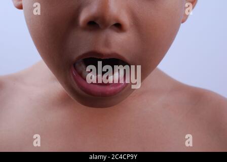 Kuala Lumpur, Malaysia - December 8, 2019 : Cute little asian boy smile and show teeth broken in Kuala Lumpur, Malaysia. Stock Photo