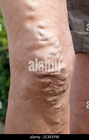 Swollen varicose veins on knee of elderly woman UK Stock Photo - Alamy