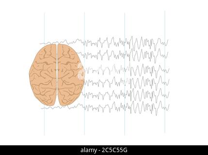 Vector illustration of human brain and abnormal brain waves waves representing focal seizure