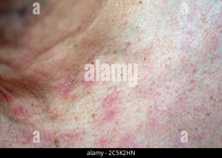 Skin reaction on a man chest after chemotherapy. Allergic reaction ...