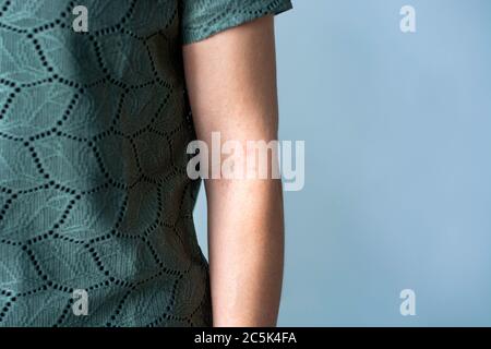 Itchy red bumps on crook of female arm / elbow. Irritated skin rash. Concept of skincare, eczema, allergy rash and other skin disease Stock Photo