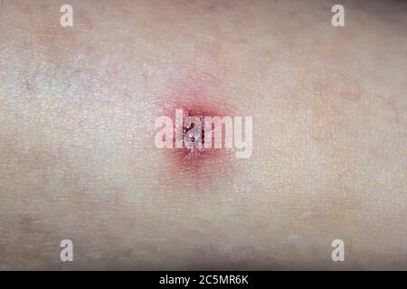 Torn wound from inflammation, acne on the human skin. Red infected ...