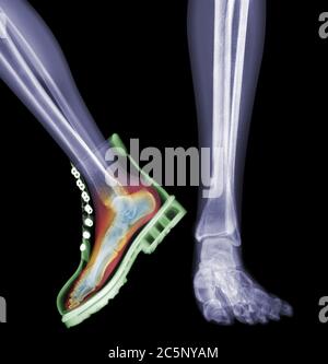 Skeleton feet with one foot in boot, coloured X-ray. Stock Photo