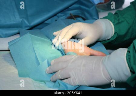 Ein Chirurg führt eine Karpaltunnel-Operation an der Hand durch Stock Photo